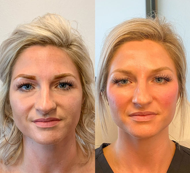 Cheek filler Before & After
