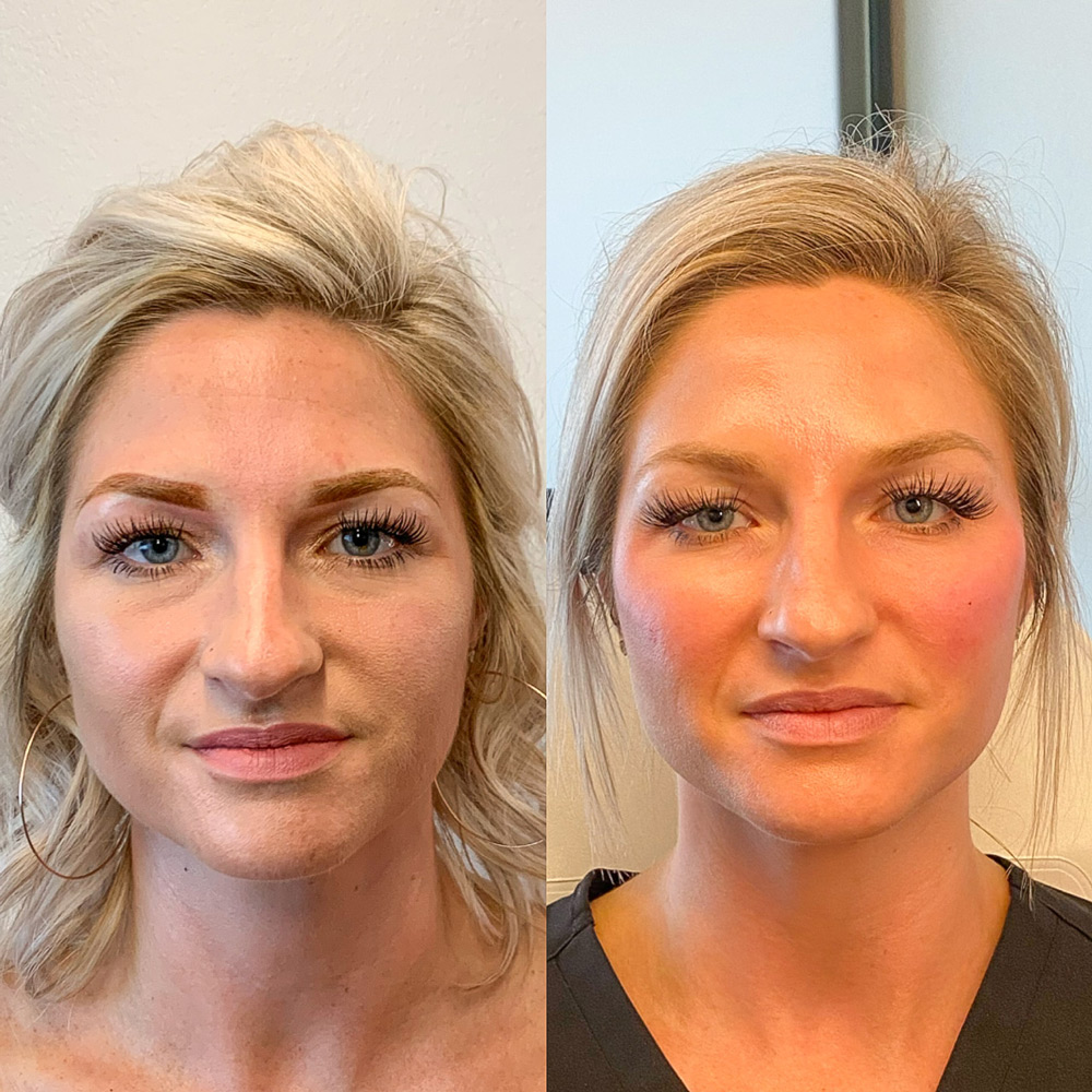 Before And After Filler In Cheeks