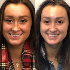 Botox-with-Boss-Gal_Before_After