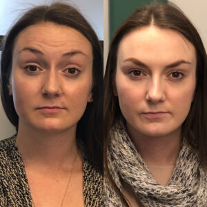 Botox-with-Boss-Gal_Before_After_2