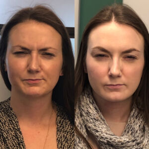 Botox-with-Boss-Gal_Before_After_3