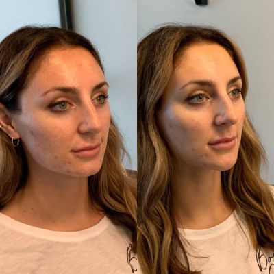 chin filler columbus