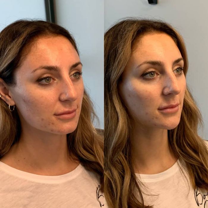 Perfect Your Profile with Chin Filler