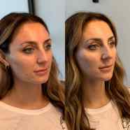 Chin Fillers Before And After Chin Fillers Before And After