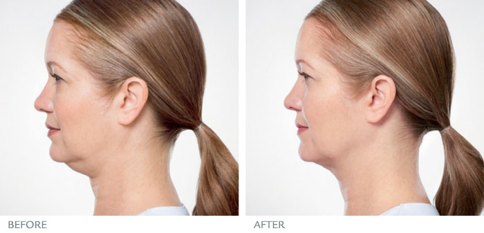 kybella-before-and-after-with-boss-gal-beauty-bar-2
