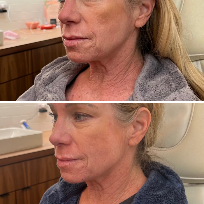 What is Radiofrequency Microneedling?