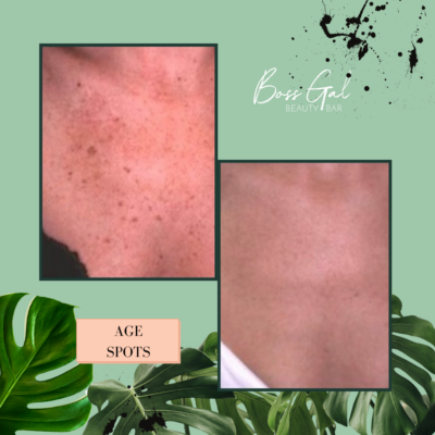 BossGal_Service-Laser-Facials-gal-03 BossGal_Service-Laser-Facials-gal-03