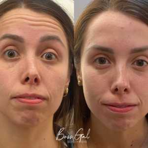 Botox before & after