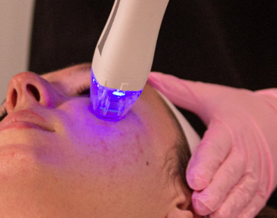 microneedling for acne scars
