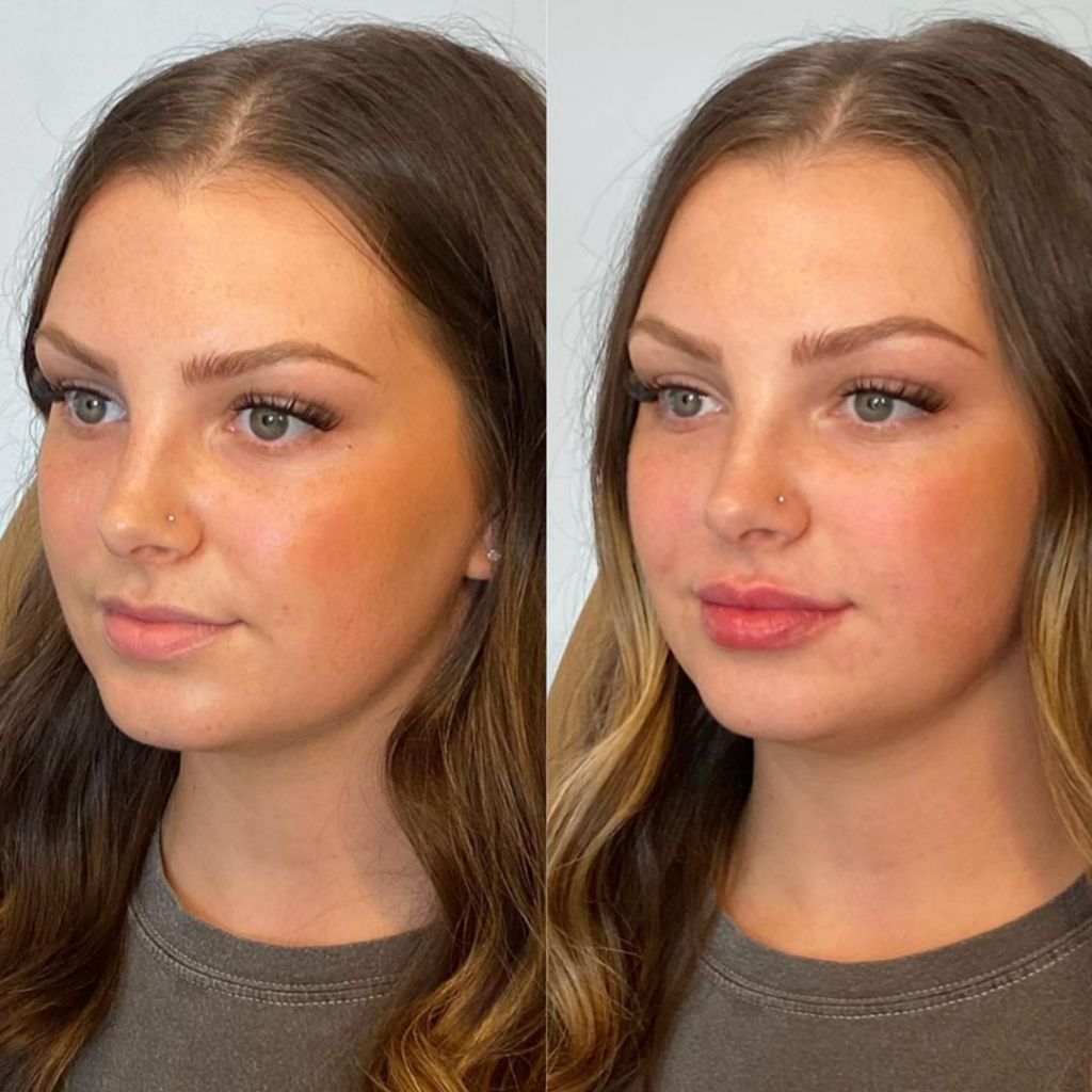 Beautiful natural lip filler results