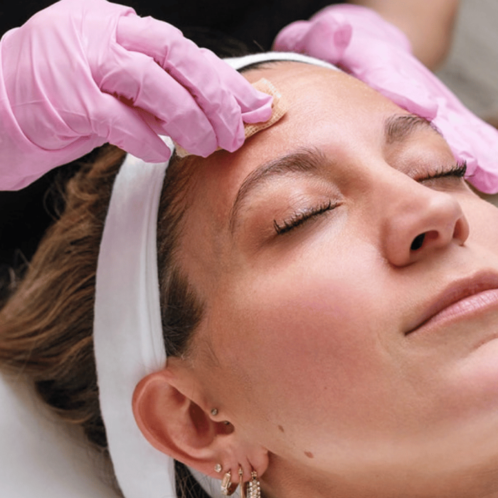 How to Choose the Right Chemical Peel for Your Skin